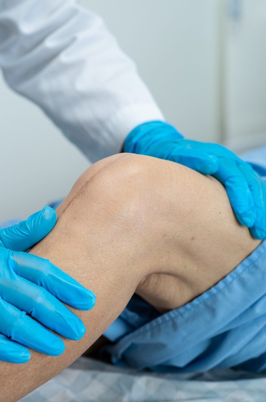Asian senior patient show her scars surgical total knee joint replacement