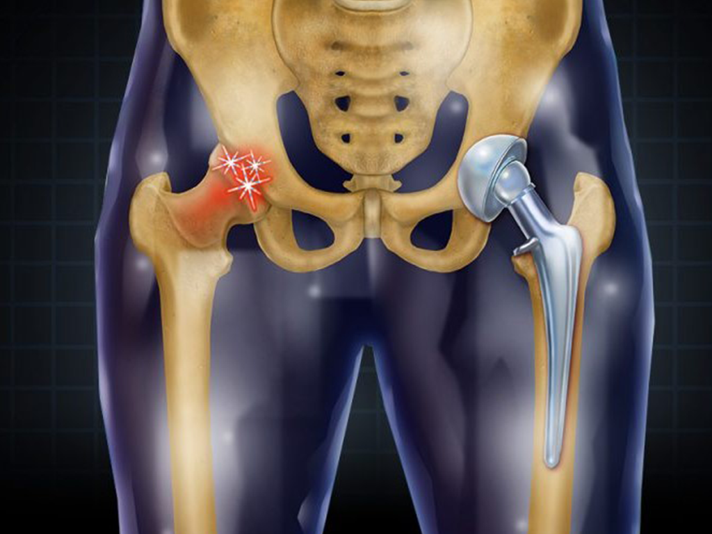 Hip-Replacement