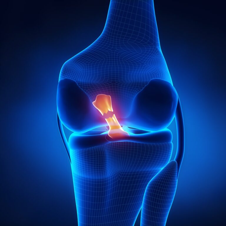 Posterior Cruciate Ligament (PCL) – Dr Abhishek Singh